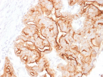 IHC staining of FFPE human ovarian carcinoma with MUC16 antibody. HIER: boil tissue sections in pH 9