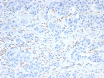 IHC staining of FFPE human kidney cancer with Sal-like 4 antibody (clone SALL4/7802R). HIER: boil ti