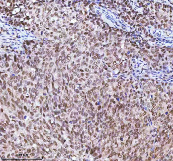 Immunohistochemical staining of RBM42 using anti-RBM42 antibody. RBM42 was detected in a paraffin-em