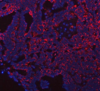 Immunofluorescent staining of FFPE human ovarian cancer tissue with PRDM15 antibody (red) and DAPI n