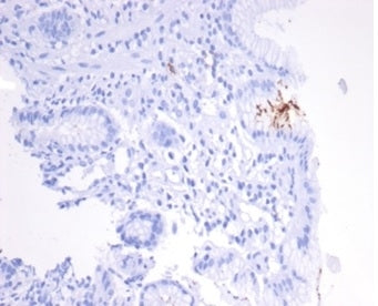IHC staining of FFPE human H. pylori-infected stomach tissue with H pylori Catalase antibody (clone 