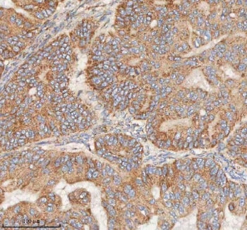 IHC staining of FFPE human ovarian tumor tissue with HDHD5 antibody. HIER: boil tissue sections in p