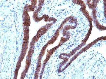 IHC: Formalin-fixed, paraffin-embedded human ovarian carcinoma stained with EpCAM antibody (clone EG