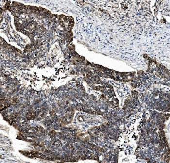 IHC staining of FFPE human ovarian serous adenocarcinoma tissue with Proteasome subunit beta type-5 