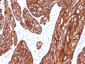 IHC staining of FFPE human squamous cell carcinoma tissue with recombinant Cytokeratin 5 antibody (c