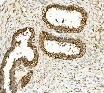 IHC staining of FFPE human breast cancer with HK1 antibody. HIER: boil tissue sections in pH8 EDTA f