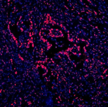 Immunofluorescent staining of FFPE human intestinal cancer with DDX5 antibody (red) and DAPI nuclear