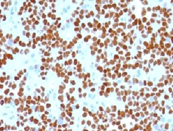 IHC testing of Ewing's sarcoma with NKX2.2 antibody (clone NK2TF-1). Staining of formalin-fixed tiss