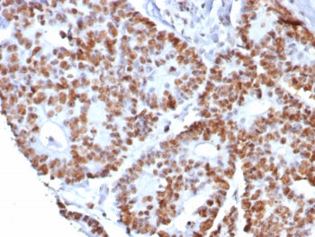 IHC staining of FFPE human colon cancer tissue with Nucleolin antibody (clone NCL/8068R). HIER: boil