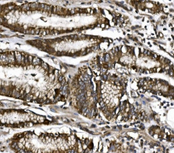 IHC staining of FFPE human gastric cancer with MitoNEET antibody. HIER: boil tissue sections in pH8 