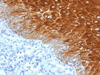 IHC testing of FFPE human basal cell carcinoma with KRT6 antibody (clone CTKN6-1). Required HIER: bo