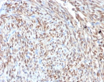 IHC staining of FFPE human liposarcoma tissue with CDK4 antibody (clone CDK4/7987R). HIER: boil tiss
