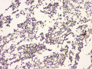 IHC staining of FFPE human glioma with APP antibody at 1ug/ml. HIER: boil tissue sections in pH6, 10