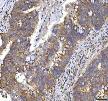 IHC staining of FFPE human rectum adenocarcinoma tissue with RASGRP3 antibody. HIER: boil tissue sec