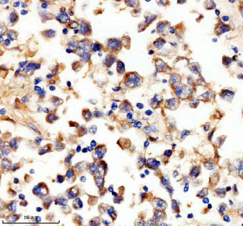 IHC staining of FFPE human testis cancer tissue with UPF1 antibody, HRP-secondary and DAB substrate.