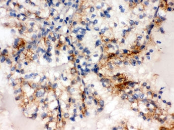 IHC testing of FFPE human renal cancer tissue with SULT2A1 antibody. HIER: Boil the paraffin section