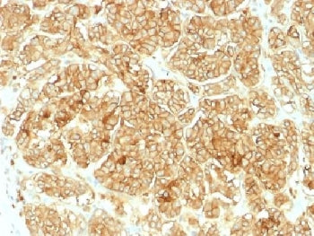 IHC testing of FFPE human renal cell carcinoma and EpCAM antibody. Required HIER: steam sections in 
