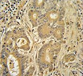 IHC testing of FFPE human colon carcinoma tissue with IMMT antibody. HIER: steam section in pH6 citr
