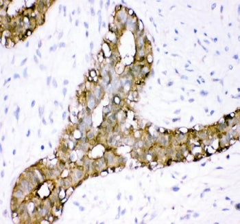 IHC staining of FFPE human breast cancer tissue with Annexin A3 antibody. HIER: boil tissue sections