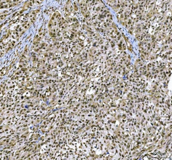 IHC staining of FFPE human bladder urothelial carcinoma tissue with c-Kit antibody. HIER: boil tissu