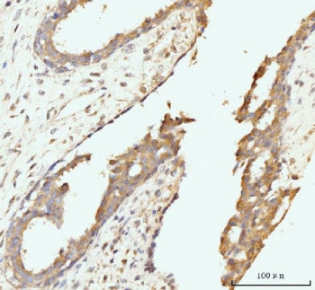 IHC staining of FFPE human breast cancer tissue with Golgin 97 antibody. HIER: boil tissue sections 