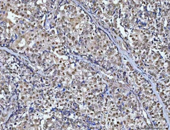 IHC staining of FFPE human ovarian cancer tissue with CHD8 antibody. HIER: boil tissue sections in p