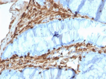 IHC testing of FFPE human colon carcinoma with Annexin A1 antibody (clone CPTC-ANXA1-1). Required HI