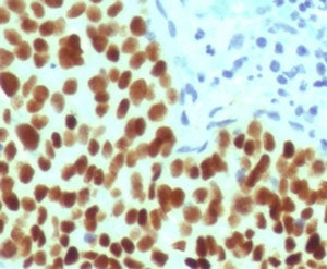 IHC staining of FFPE human cervical carcinoma with recombinant SOX2 antibody (clone SBX2-1R). HIER: 