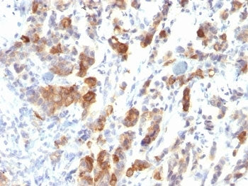IHC: Formalin-fixed, paraffin-embedded human gastric carcinoma stained with MUC5AC antibody (MUC5AC/