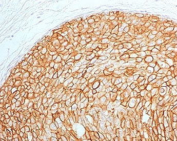 IHC testing of FFPE human breast carcinoma with ErbB2 antibody (clone 2KRI7-2). HIER: boil tissue se