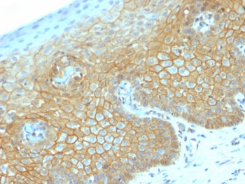 IHC testing of FFPE human cervical carcinoma with recombinant b-Catenin antibody (clone CTNNB1/2030R