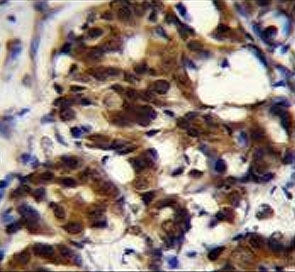 IHC testing of FFPE human breast carcinoma tissue with TRADD antibody. HIER: steam section in pH6 ci