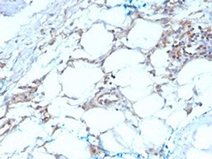 IHC testing of FFPE human mesothelioma with Calretinin antibody (clone CALB2/2603). HIER: boil tissu