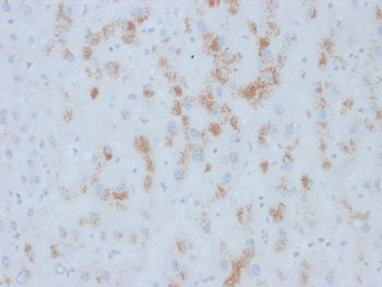 IHC testing of FFPE human hepatic carcinoma with TdT antibody (clone M12P4H2). Required HIER: boil t