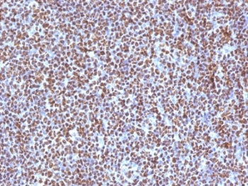 IHC testing of FFPE anaplastic large-cell lymphoma with ALK antibody (clone ALK/1504). HIER: boil ti