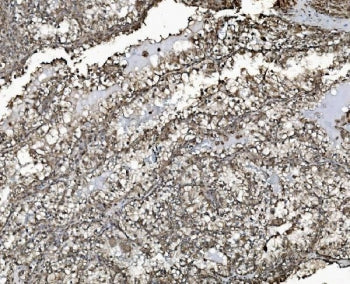 IHC staining of FFPE human renal clear cell carcinoma tissue with Prohibitin 2 antibody. HIER: boil 