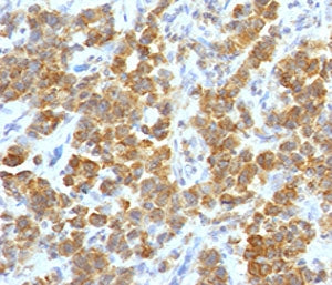 IHC testing of FFPE human parathyroid tumor with TL1A antibody (clone TLRM1-1). Staining of FFPE tis