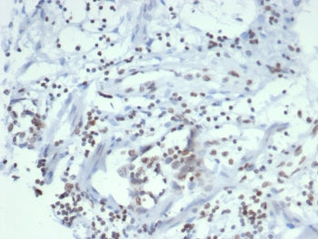 IHC staining of FFPE human ovarian carcinoma tissue with Estrogen Sulfotransferase antibody (clone S