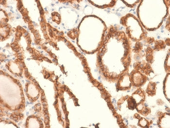 IHC testing of FFPE human thyroid carcinoma and recombinant EpCAM antibody (clone EGP40/2041R). Requ