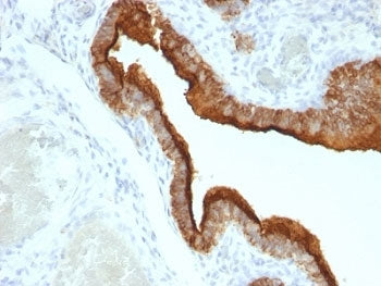 IHC: Formalin-fixed, paraffin-embedded human ovarian carcinoma stained with MUC-1 antibody (clone HM