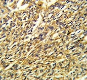 IHC testing of FFPE human lung carcinoma tissue with KCNJ2 antibody. HIER: steam section in pH6 citr