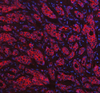Immunofluorescent staining of FFPE human breast cancer tissue with HGPRTase antibody (red) and DAPI 