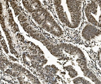 IHC staining of FFPE human rectal cancer with hnRNP D antibody. HIER: boil tissue sections in pH8 ED