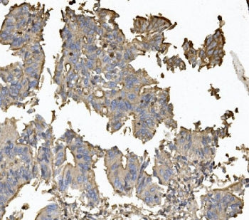 IHC staining of FFPE human rectal cancer with CLDN5 antibody. HIER: boil tissue sections in pH8 EDTA for 20 min and allow to cool before testing.