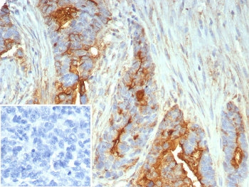 IHC staining of FFPE human ovarian cancer tissue with Mucin 1 antibody (clone MUC1/7797R). Inset: PB