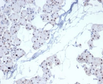IHC staining of FFPE human renal cell carcinoma with recombinant PHOX2B antibody (clone PHOX2B/7161R