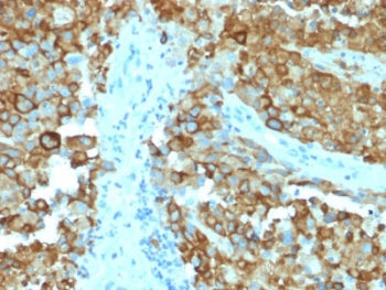 IHC testing of human melanoma with Melanoma gp100 antibody (clone PMEL/2038). Required HIER: boil ti