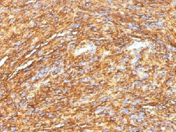IHC testing of FFPE human gastrointestinal stromal tumor (GIST) with DOG 1 antibody (DG1/1484). Requ