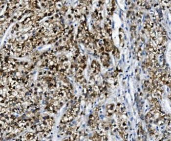 IHC staining of FFPE human liver cancer with Paraoxonase 1 antibody. HIER: boil tissue sections in p