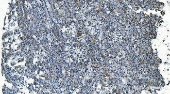 IHC staining of FFPE human liver cancer with MCU antibody. HIER: boil tissue sections in pH8 EDTA fo